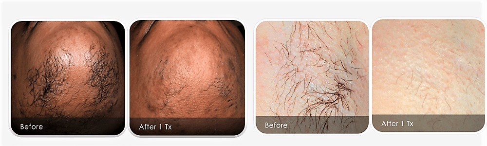 Before-and-after laser hair removal results showing reduced hair growth following professional laser hair removal treatment.