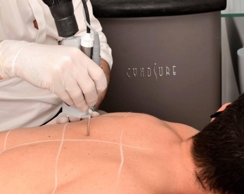 Laser hair removal treatment on men's back.