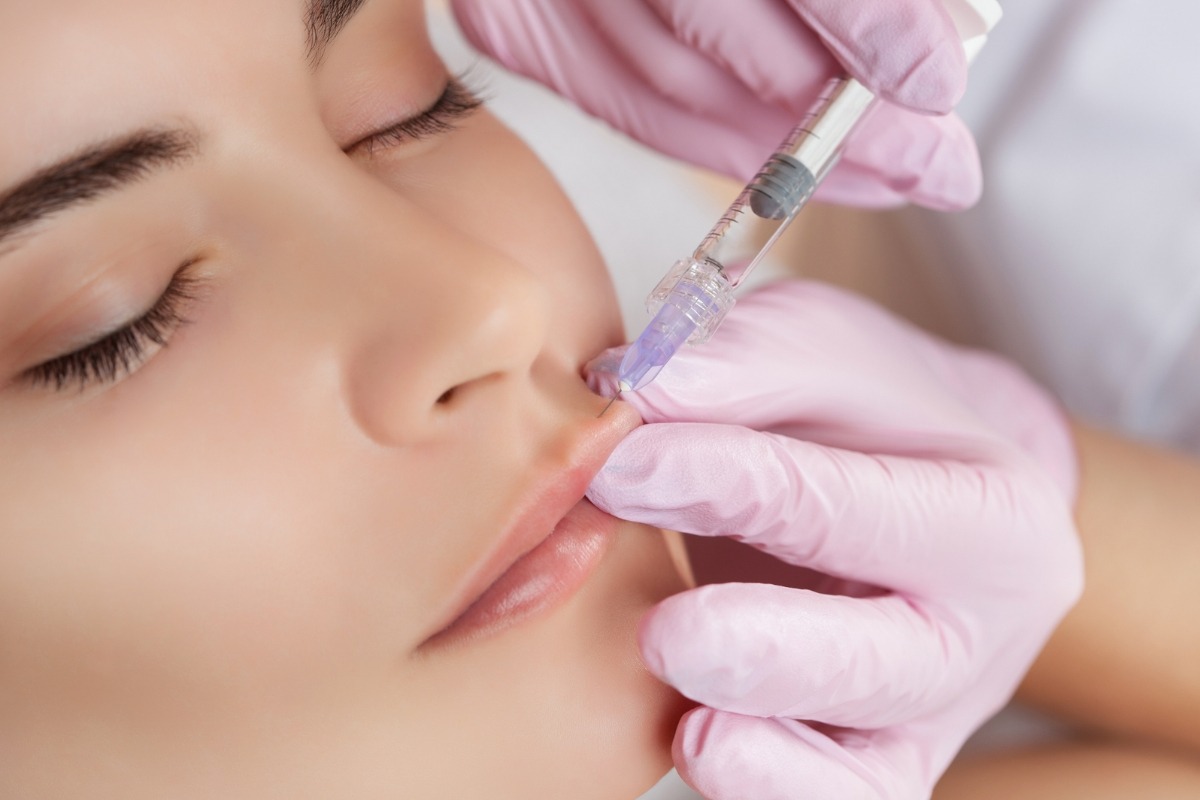 Lip filler treatment at Prima Britannia Laser Clinic Hammersmith, London