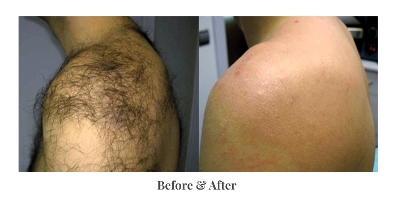 Men's back laser hair removal results after treatment