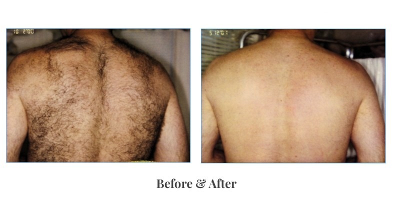 men's back laser hair removal before and after results