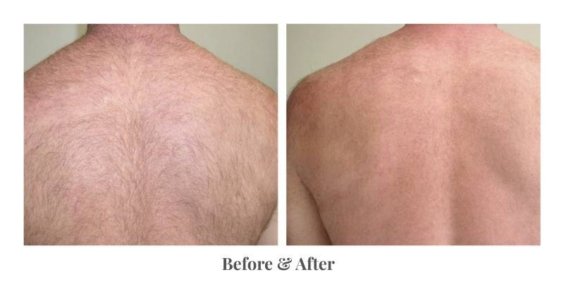 Laser hair removal treatment on the back area using an Alexandrite laser  